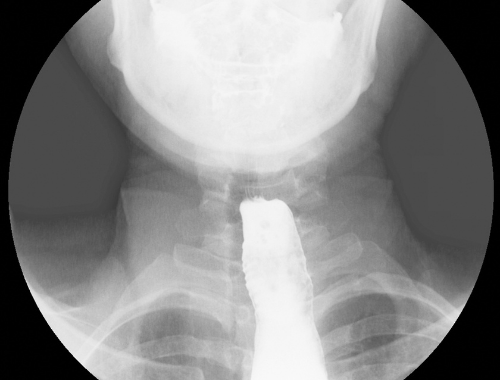 Différence entre l'achalasie et la gastroparésie