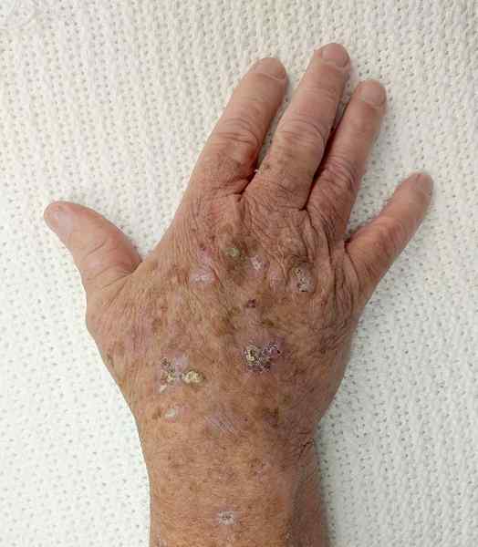 Diferencia entre la queratosis actínica y la psoriasis