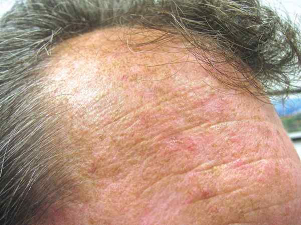 Perbedaan antara keratosis aktinik dan karsinoma sel skuamosa