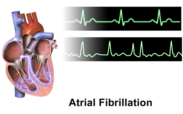 Diferencia entre AFIB y CHF