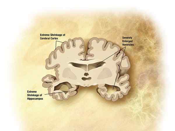 Unterschied zwischen Alzheimer -Krankheit und Demenz mit Lewy -Körpern