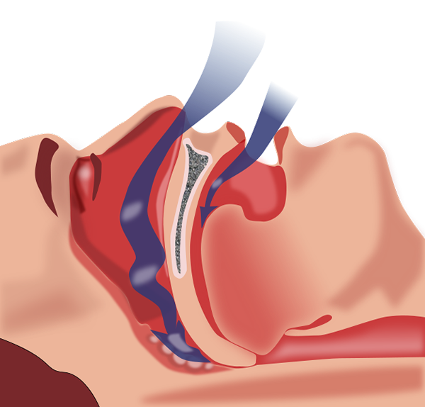 Diferencia entre apnea e hipopnea