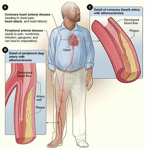 Unterschied zwischen Arteriosklerose und Atherosklerose