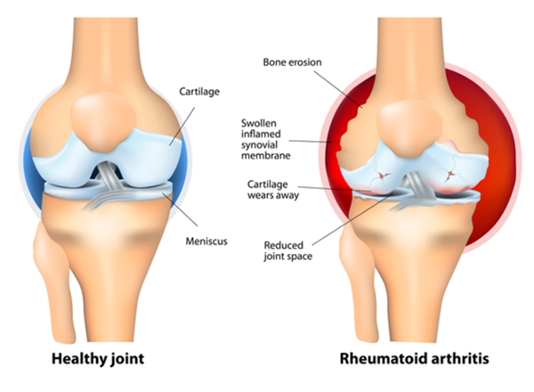 Différence entre l'arthrite et la bursite