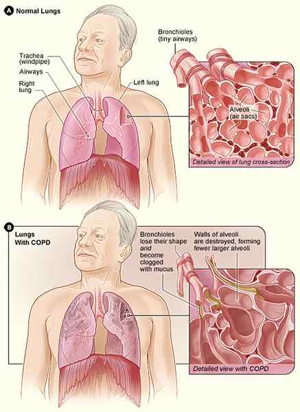 Diferencia entre la asbestosis y la enfermedad pulmonar obstructiva crónica (EPOC)