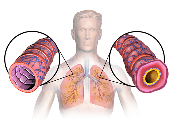 Unterschied zwischen Asthma und Allergien