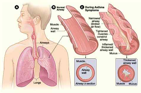 Unterschied zwischen Asthma und COPD