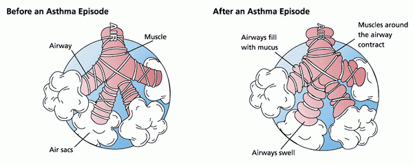 Différence entre l'asthme et l'emphysème