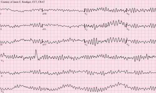 Unterschied zwischen atrialem und ventrikulärem Fibrillation