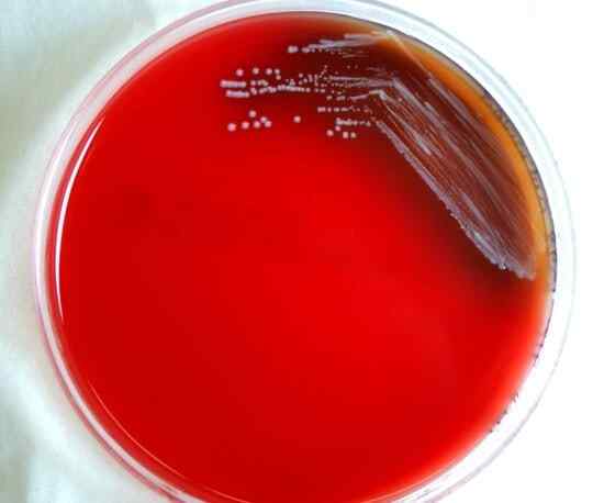 Perbedaan antara bakteremia dan sepsis