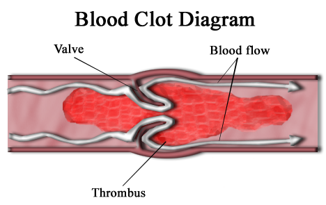 Diferencia entre el coágulo de sangre y el aneurisma
