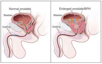 Diferencia entre BPH y cáncer de próstata