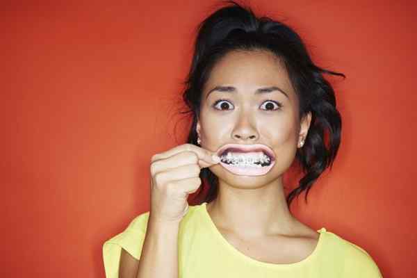 Unterschied zwischen Zahnspangen und Retainern