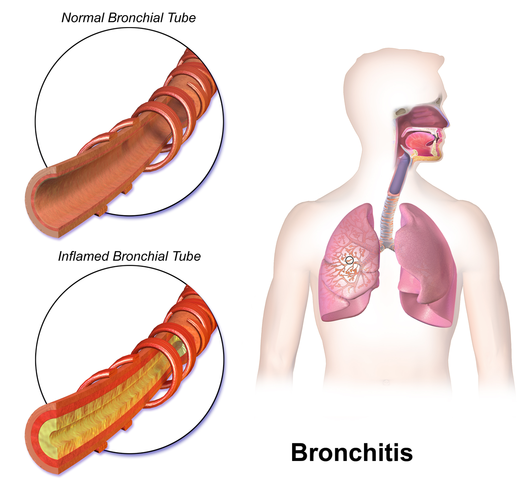 Perbedaan antara bronkitis dan bronkiolitis