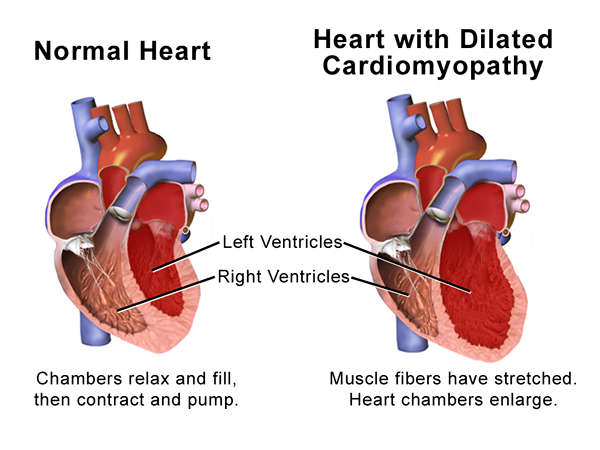 Diferencia entre la miocardiopatía y la insuficiencia cardíaca