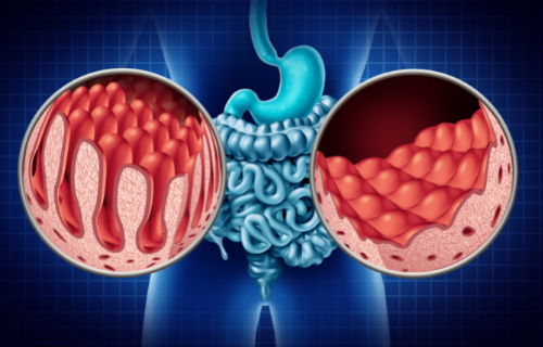 Diferencia entre la enfermedad celíaca y la colitis ulcerosa