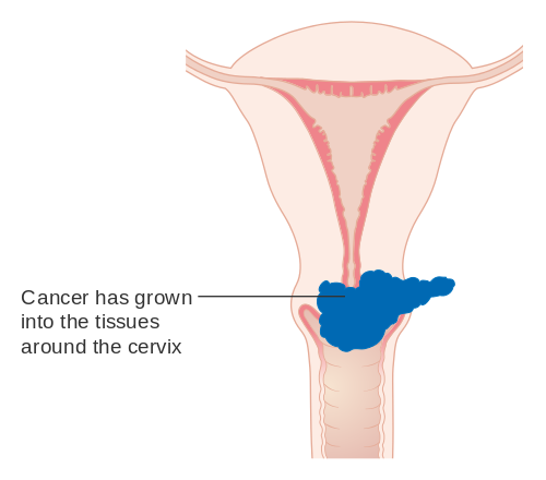 Diferencia entre el cáncer cervical y el VPH