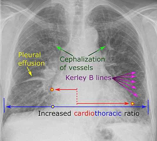 Diferencia entre la CHF y la insuficiencia renal