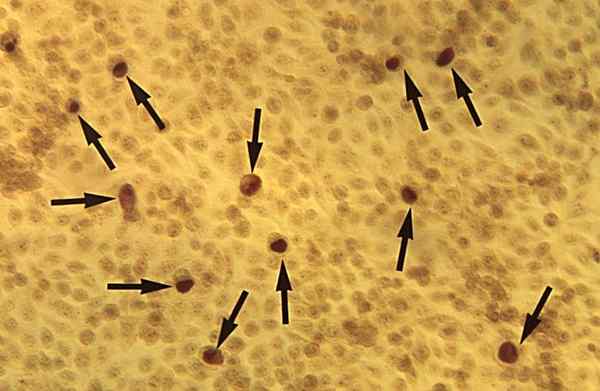 Perbedaan antara Chlamydia dan Trichomonas