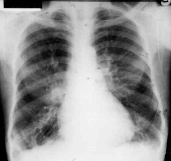 Unterschied zwischen chronischer Bronchitis und Emphysem