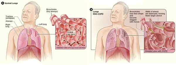 Différence entre la MPOC et le traitement de l'asthme