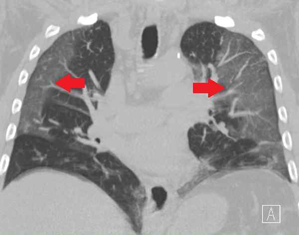 Perbedaan antara pneumonia Covid dan pneumonia bakteri