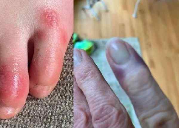 Diferencia entre los dedos de los pies covid y el pie del atleta