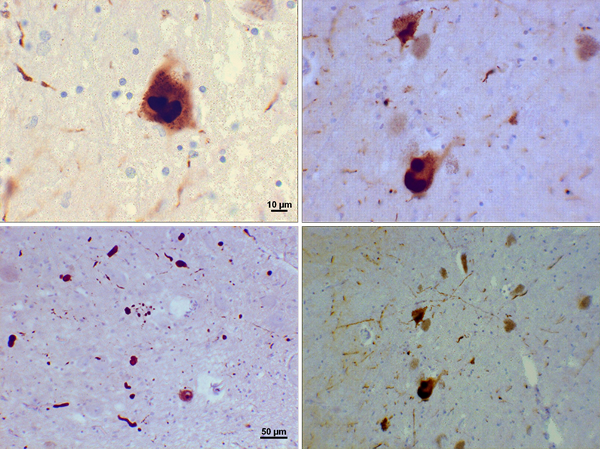 Unterschied zwischen Demenz mit Lewy -Körpern und Parkinson