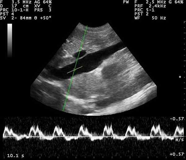 Perbedaan antara Doppler dan dupleks