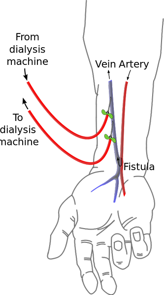 Perbezaan antara fistula dan rasuah