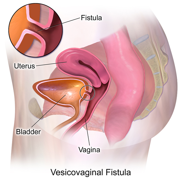 Perbedaan antara fistula dan shunt