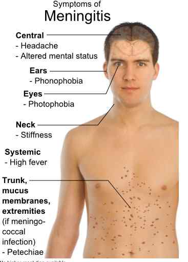 Unterschied zwischen Grippe und Meningitis