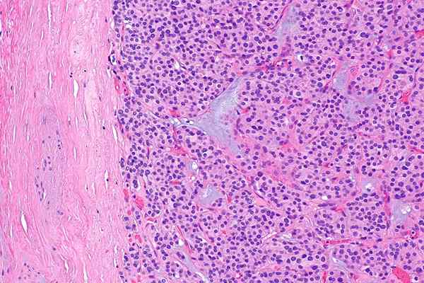 Perbezaan antara adenoma folikel dan karsinoma