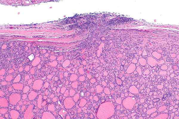 Diferencia entre el cáncer de tiroides folicular y el cáncer de tiroides papilar