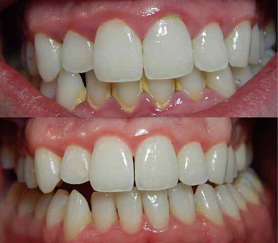Diferencia entre la gingivitis y la periodontitis