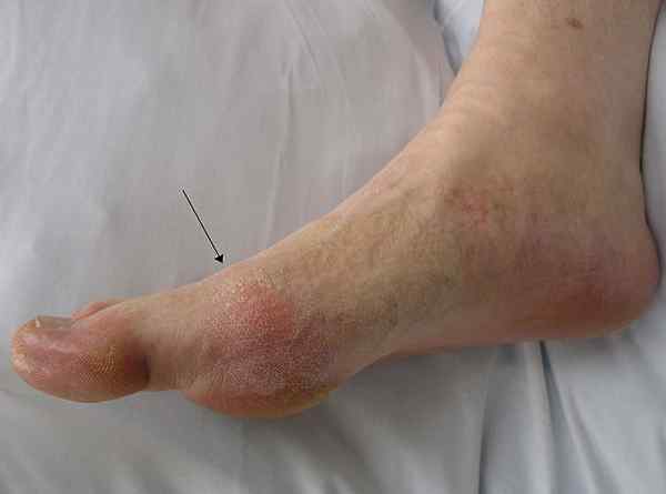 Perbezaan antara gout dan plantar fasciitis