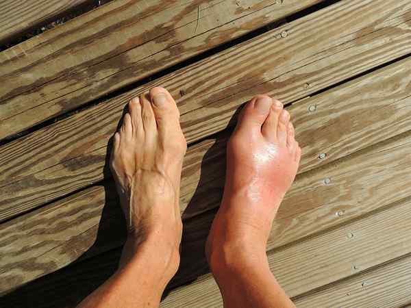 Perbezaan antara gout dan arthritis rheumatoid