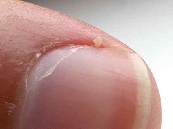 Unterschied zwischen Hangnail und eingewachsenem Nagel
