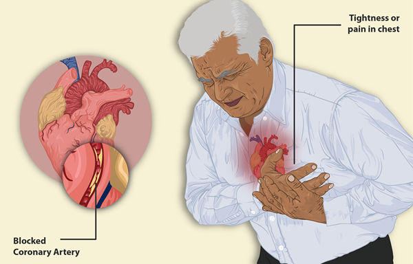 Différence entre la crise cardiaque et l'insuffisance cardiaque