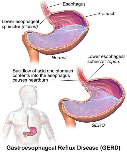 Diferencia entre acidez estomacal y angina