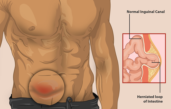 Diferencia entre hernia y úlcera