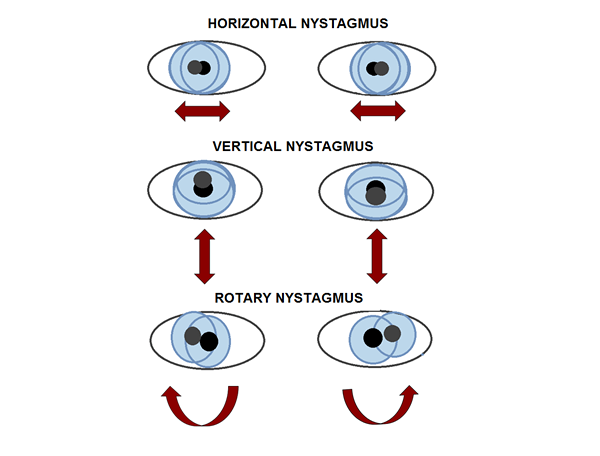 Différence entre le nystagmus horizontal et le nystagmus vertical