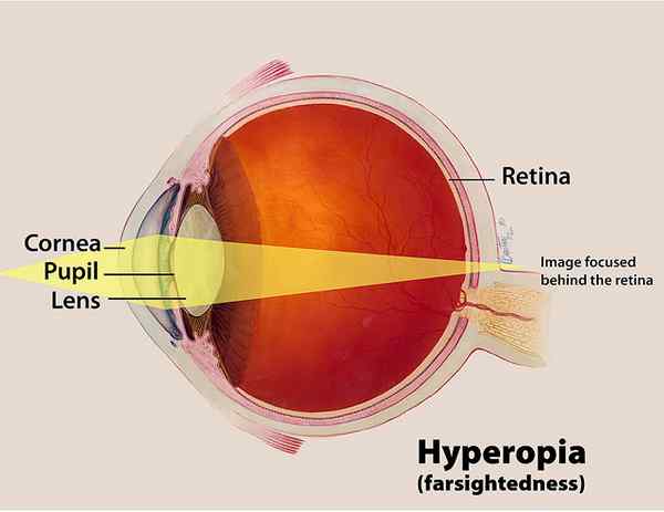 Perbezaan antara hyperopia dan presbyopia