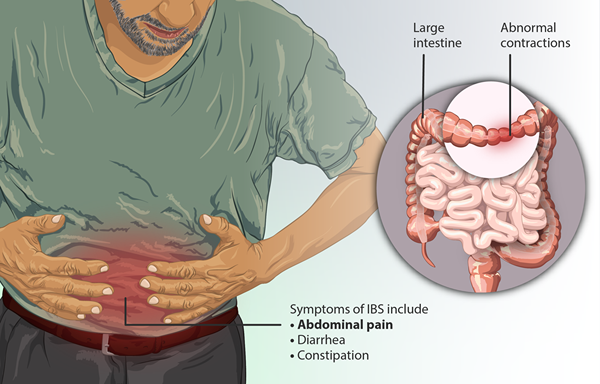 Différence entre le syndrome du côlon irritable IBS et la colite ulcéreuse