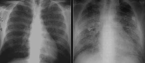 Diferencia entre el infiltrado pulmonar y la consolidación