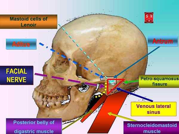 Unterschied zwischen Mastoiditis und Otitis Media