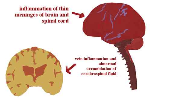 Unterschied zwischen Meningitis und Enzephalitis