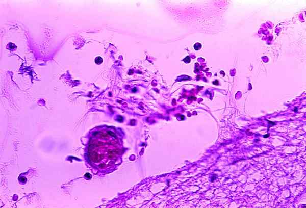 Perbezaan antara meningokokus dan meningitis