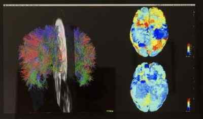 Różnica między MRI i FMRI