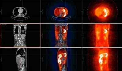 Unterschied zwischen MRT und PET -Scan